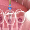 Where to get root canal?