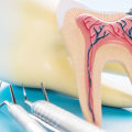 Where is root canal pain?
