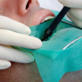 Where does a root canal hurt?