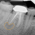 What are the dangers of root canals?