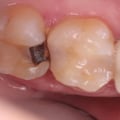 How do you know if an old root canal is infected?