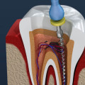 Pain where root canal years later?
