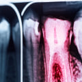 Will root canal stop gum pain?