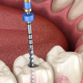 Where is root canal treatment?