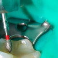 Where do root canals hurt?