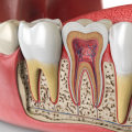 Can root canal infection spread?
