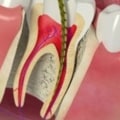 Why root canal is needed?