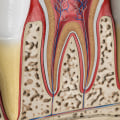 When is root canal needed?