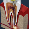 What do you do if an old root canal hurts?
