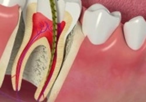 Are root canal bad?
