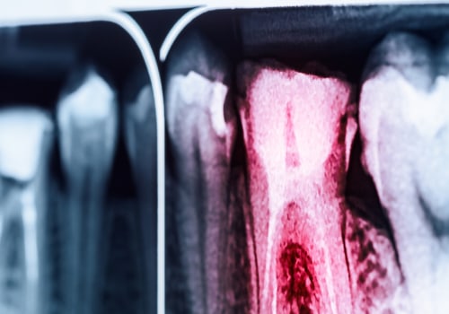 Will root canal stop gum pain?