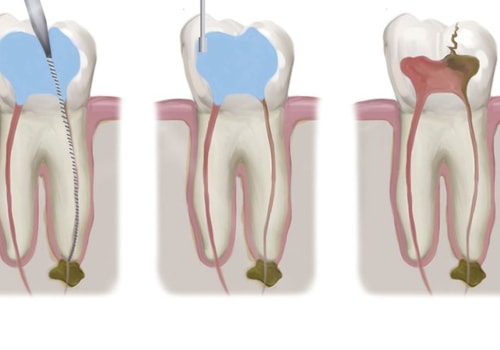How many steps are there in root canal treatment?