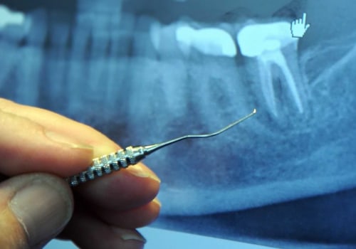 Are root canal teeth harder to extract?