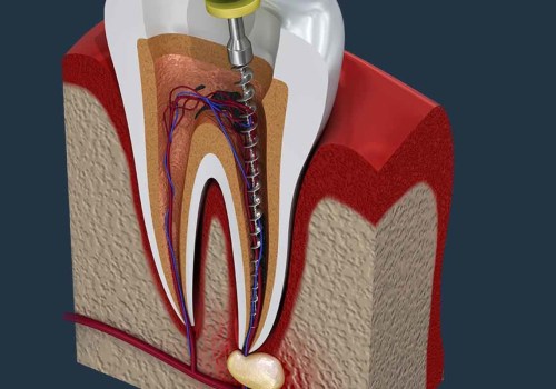 How fast does root canal infection spread?