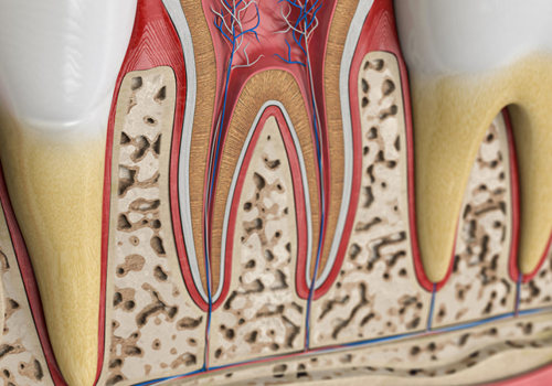 When is root canal needed?